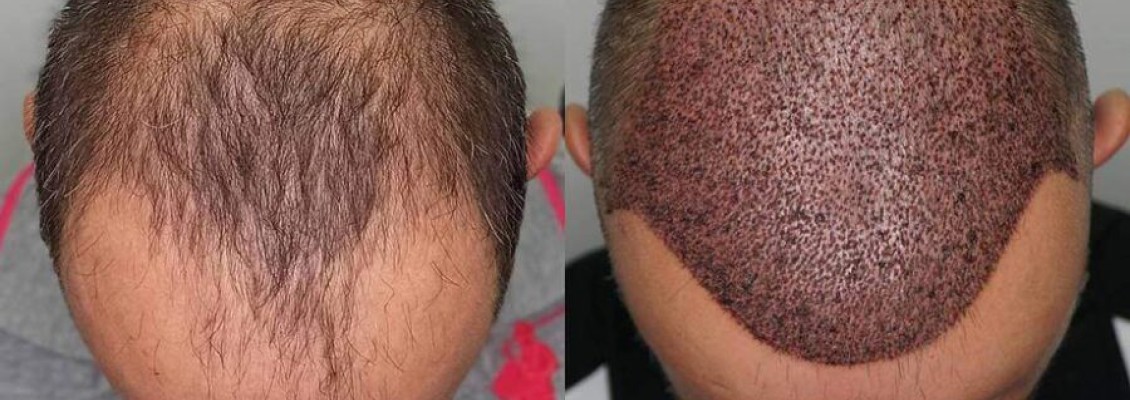 5000 Greft Saç Ekimi