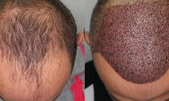 5000 Greft Saç Ekimi