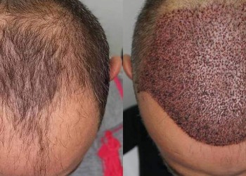 5000 Greft Saç Ekimi